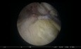 BipoEP – Bipolare Prostata-Enukleation