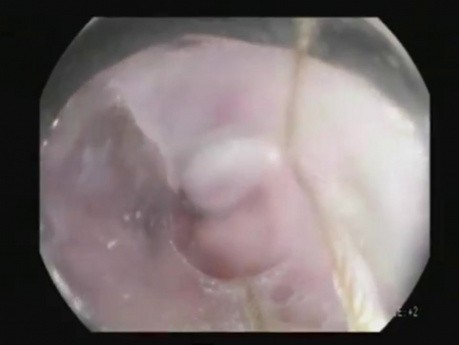 Endoskopische Varizenbandligatur