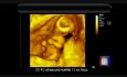 3D 4D-Ultraschallaufnahme von einem normalen Fötus in der 13. SSW