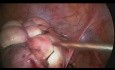 Laparoskopische Myomektomie zur Rettung der Gebärmutter bei großen multiplen Fibroiden
