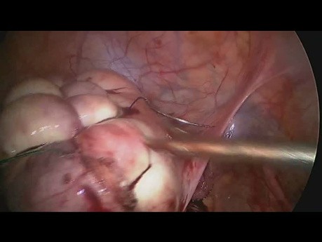 Laparoskopische Myomektomie zur Rettung der Gebärmutter bei großen multiplen Fibroiden
