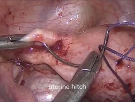 Laparoskopische uterovaginale Anastomose für zervikale Agenesie
