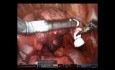 Robotische Mittellobektomie der Lunge