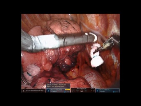 Robotische Mittellobektomie der Lunge