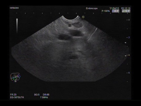 EUS - Stenose des Ductus choledocus