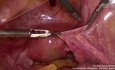 Ovarian Transposition for Cervical Cancer