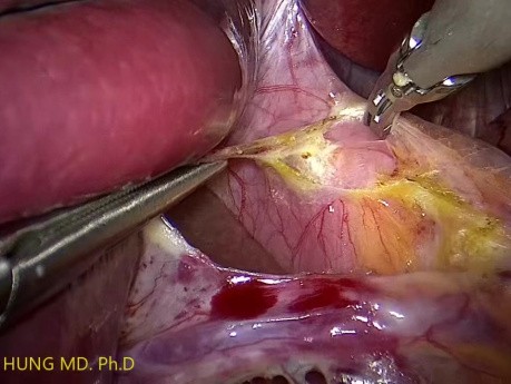 Laparoskopische Myotomie nach Heller