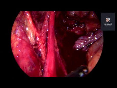 Tief infiltrierende Endometriose hinteres Kompartiment en bloc Resektion
