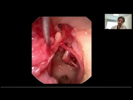 Endoskopische Anatomie des Ohrs