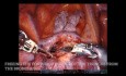 Roboter assistierte rechte obere Lungenlappenresektion, nicht bearbeitet - EINFACH