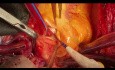 Pulmonal- und Aortenklappen Endokarditis und Fistel