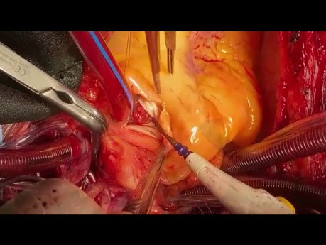 Pulmonal- und Aortenklappen Endokarditis und Fistel