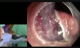 Endoskopische Submukosadissektion (ESD) den Rektaladenom - dr Makota Nischimura.