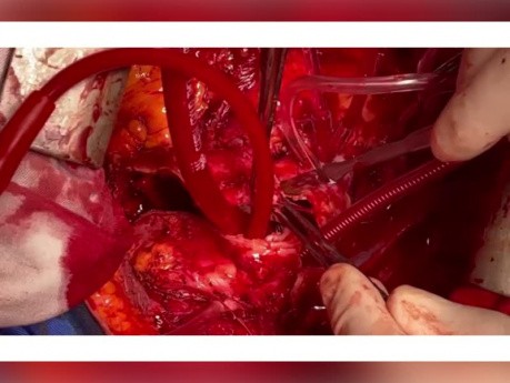 Vollständiger Ersatz des Aortenbogens und gleichzeitiger Ersatz der absteigenden thorakoabdominalen Aorta