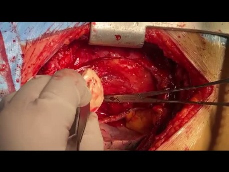 Patientin mit VCSS und bakterieller Endokarditis und Endophelbitis nach Resektion der Vena Cava Superior und Wiederherstellung mit Homograft
