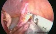 Laparoskopische Ovarialzystektomie