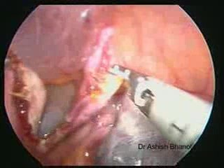 Laparoskopische Ovarialzystektomie