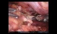 Mediastinaltumor