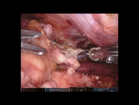 Mediastinaltumor