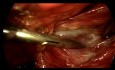 Laparoskopische Hernienoperation nach dem TEP-Verfahren ohne Elektrokoagulation