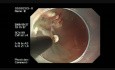 Endoskopische submuköse Dissektion des Gastroösophageal-Verbindung Karzinoms, stammend aus Lang-Segment-Barret-Ösophagus