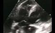 Ein Fall von Lungenembolie mit Thrombus im Transit