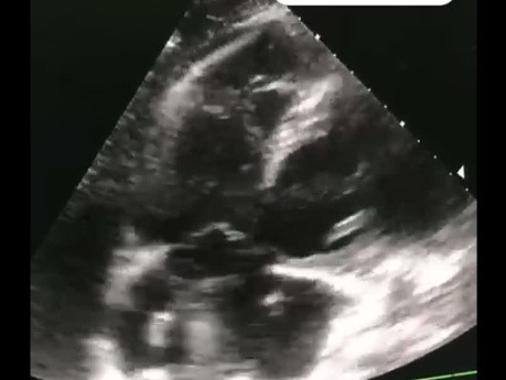 Ein Fall von Lungenembolie mit Thrombus im Transit