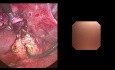 Laparoskopische Cholezystektomie + Gallengangserkundung durch Choledoskopie