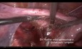 Laparoskopische Myomektomie: ein Myom im Ligamentum latum uteri