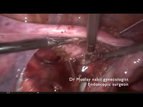 Laparoskopische Myomektomie: ein Myom im Ligamentum latum uteri