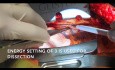 Entnahme der Arteria mammaria interna mithilfe des harmonischen Skalpells