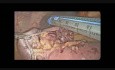 Die laparoskopische Entfernung des blutigen GIST - Tumor des Dünndarmes