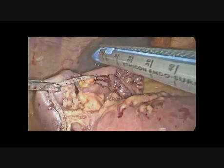 Die laparoskopische Entfernung des blutigen GIST - Tumor des Dünndarmes
