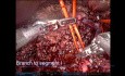 Roboterassistierte Chirurgie zur Durchführung einer zentralen Hepatektomie mit Erweiterung auf Segment 1 bei Cholangiokarzinom