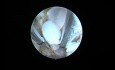 Adenomyose- die Endometriumablation