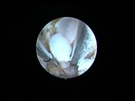 Adenomyose- die Endometriumablation
