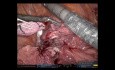 Doppelte Lobektomie eines Tumors mit einem Roboter