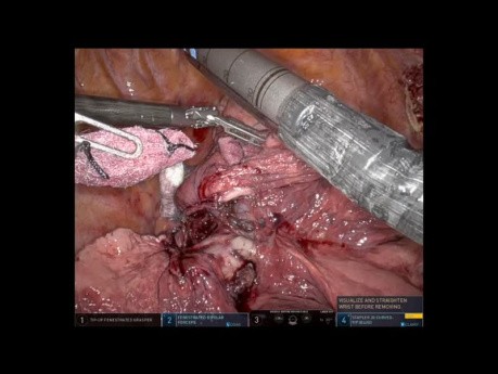 Doppelte Lobektomie eines Tumors mit einem Roboter