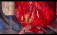 Re-Operation an der Aortenwurzel 2