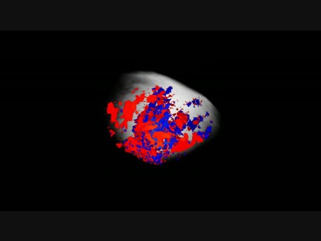 Chorionkarzinom (Doppler)