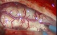 Arnold-Chiari-Syndrom mit Syringomyelie