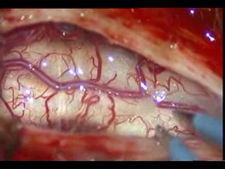 Arnold-Chiari-Syndrom mit Syringomyelie