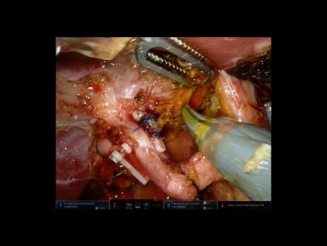 Robotergestützte extrahepatische Gallenwegresektion mit Roux-en-Y Hepaticojejunostomie für Typ-II-Klatskin-Tumor
