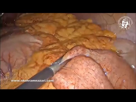 Anastomosen-Magenbypass als erneute Operation nach fehlgeschlagener Schlauchmagenresektion