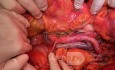 Präkavale rechte Nierenarterie während der Lymphadenektomie bei Endometriumkarzinom