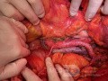 Präkavale rechte Nierenarterie während der Lymphadenektomie bei Endometriumkarzinom