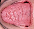 Rissige Zunge