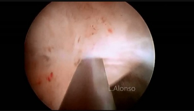Das Asherman-Syndrom