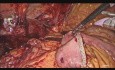 Laparoskopische Hepatikojejunostomie bei iatrogener Gallengangsverletzung