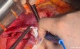 Resektion von Lebermetastasen mit Komplikation einer Verletzung der rechten Lebervene: Kontrolle und Rekonstruktion
